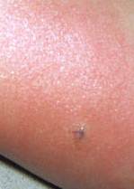 Symptoms-Of-Mosquito-and-Insect-Bite